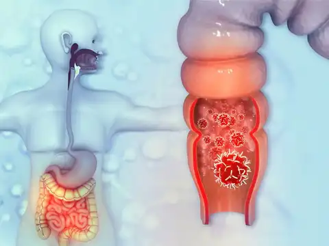  Rectal bleeding is not always harmless