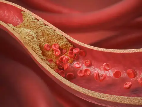  Blood flow becomes chaotic, clot risk climbs