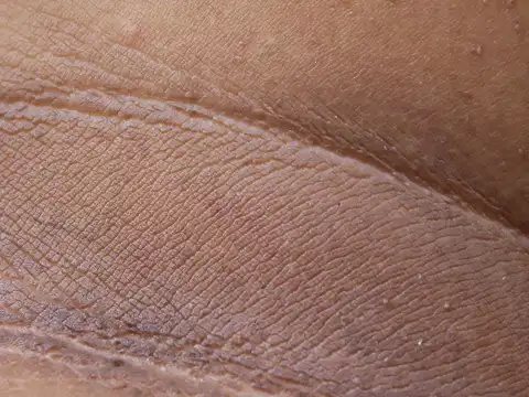  Inner lining breaks down, inflammation fires up