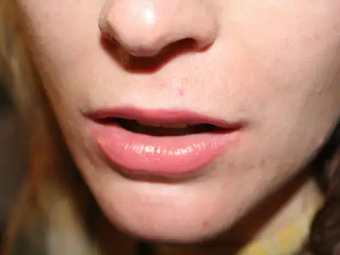 Rash Around the Mouth