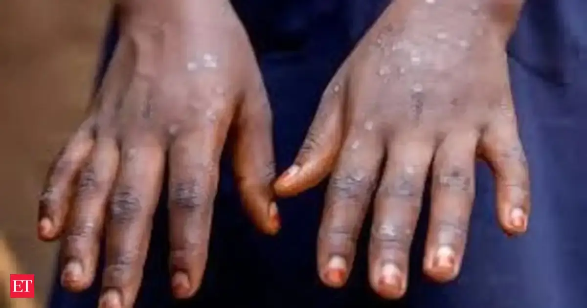 Genetic analysis links Kerala's 2024 mpox outbreak to international travel