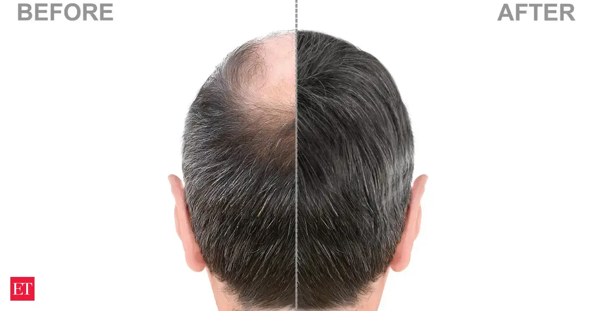 Hair regrowth herb: Study says this ancient medicinal root could help reverse hair loss