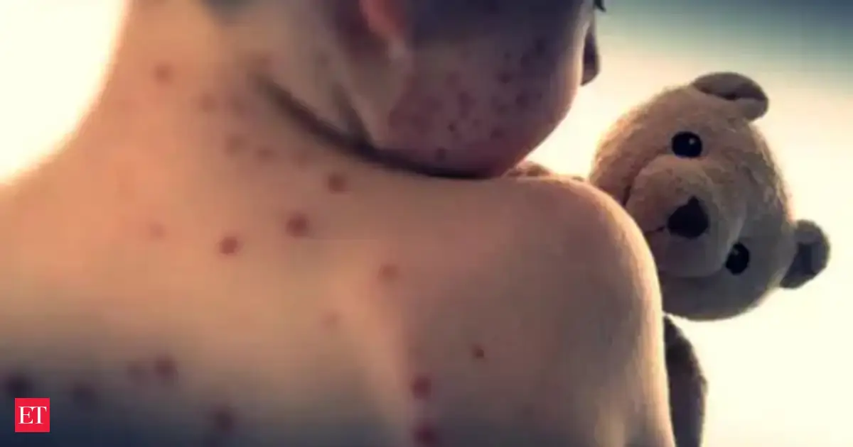 Worst US measles outbreak in 30 years: South Carolina, Florida battles health crisis, several college campuses hit badly