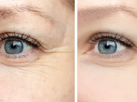 What botox actually is