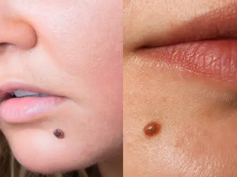 Common features of moles