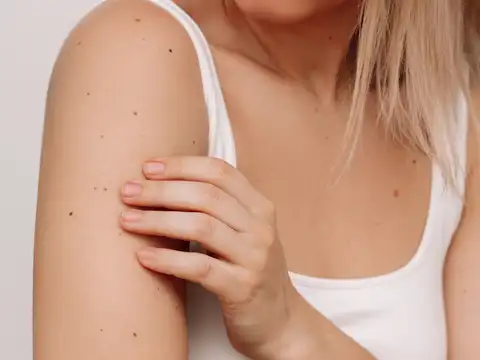 Mole vs other skin spots