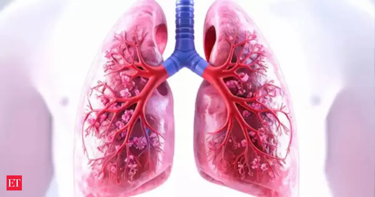 Tuberculosis rates spike in northern Saskatchewan, NDP alleges government withheld case information