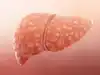 Liver disease crisis: 130 crore people already affected; what we eat and how we live may worsen the risk by 2050