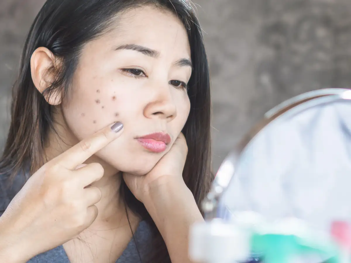 Sun protection is must - Dark spots making you look older: Here is how to  reverse Hyperpigmentation