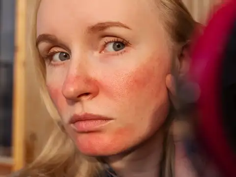 Redness and burning