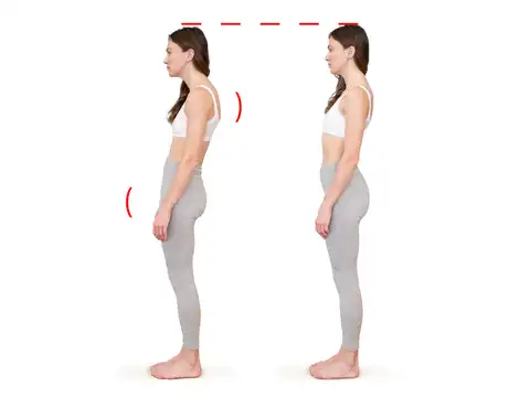 Sway back imbalance