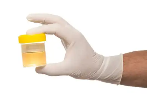 Foamy Or Bubbly Urine