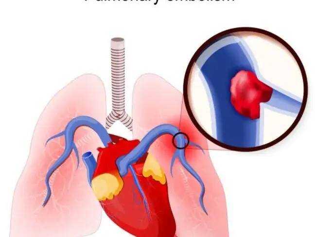 Pulmonary Embolism