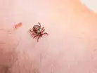 Anaplasmosis, a new tick-borne disease is rising in Canada and here’s why doctor:Image