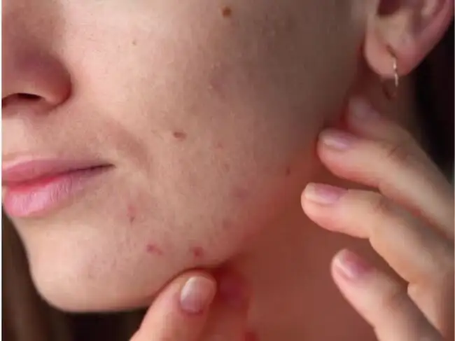 pimples can be fatal sometimes