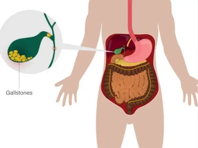 Gall Stones