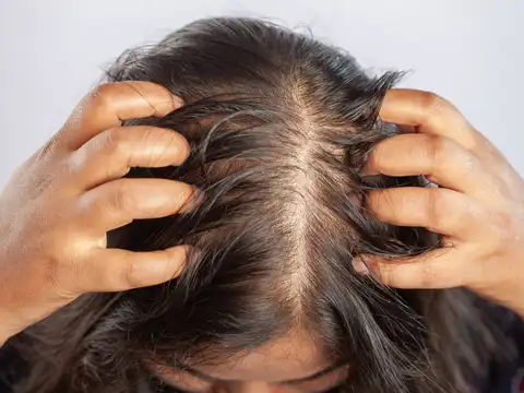 Hair Loss or Thinning