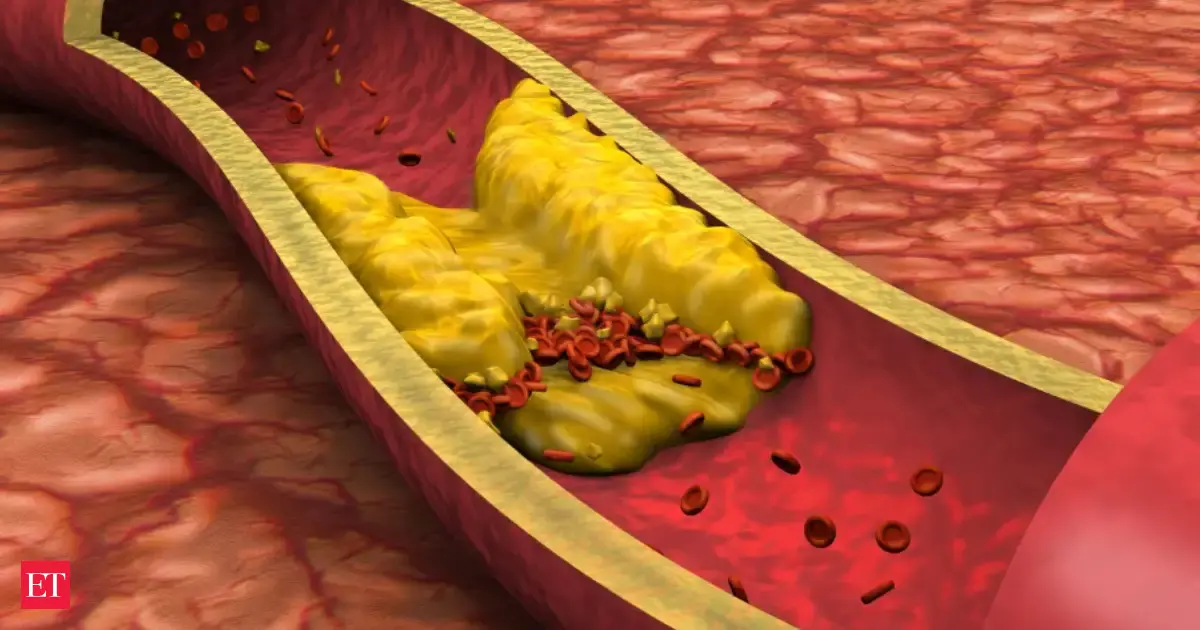 Us Cardiologists Issue New Guidelines On How To Manage Cholesterol