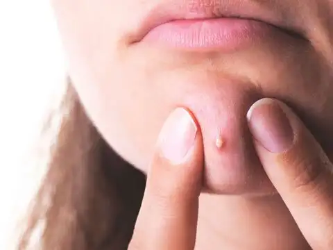 Use It To Soothe Acne Prone Skin Overnight