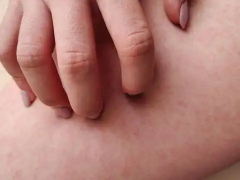  Apply It On Insect Bites And Minor Skin Irritations