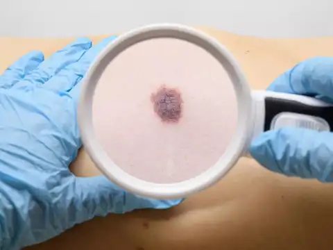 The bigger opportunity: beyond melanoma