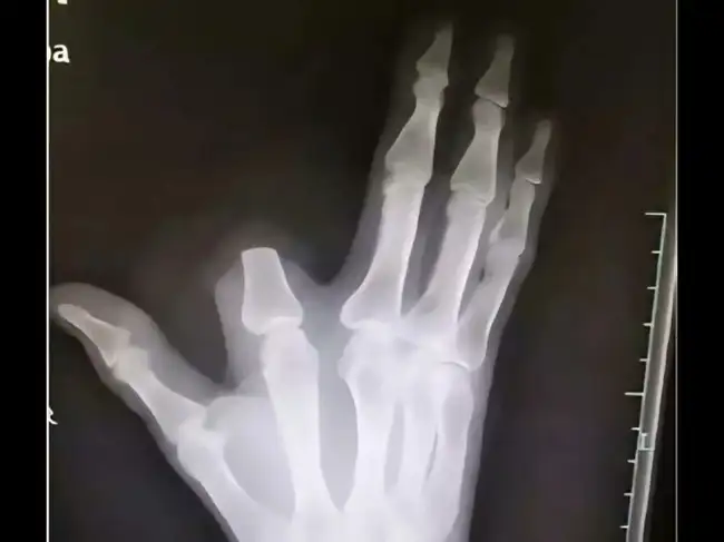 A 60-year-old Chinese farmer chopped off his right index finger after a ...