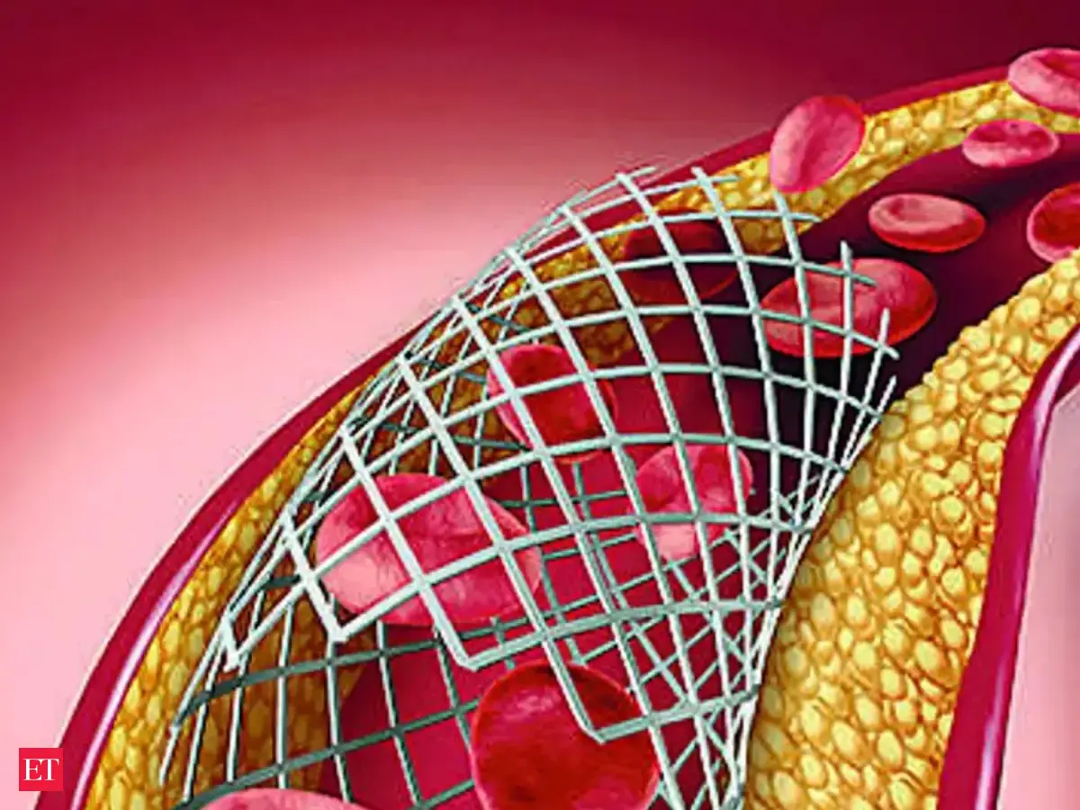 Health ministry asked to examine coronary stent safety concerns