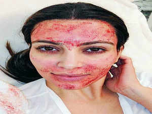 Anything for beauty: Indians are falling for vampire facials