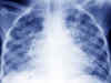 Common antacid may treat tuberculosis: Study