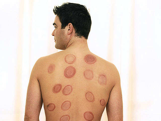 Cost & cons - All you need to know about cupping therapy | The Economic  Times