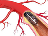The cuts that complicate efforts to cap stent price