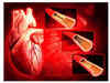 Profit on stents ranges from 270% to 1,000%