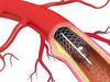 Stents sold in Europe for less than Indian prices