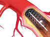MRP of stents, valves must now be declared