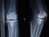 NPPA threatens legal action against 40 hospitals for not displaying knee implant prices