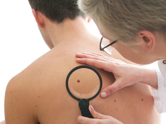 Men, listen up! If you take asprin daily, you may double the risk of melanoma