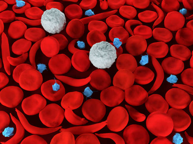 Sickle cell anemia1_ThinkstockPhotos