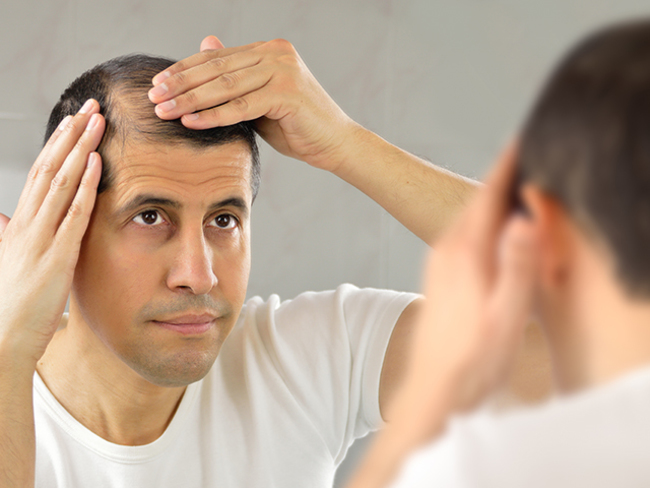 Qu'est-ce qui cause la perte de cheveux chez les hommes?