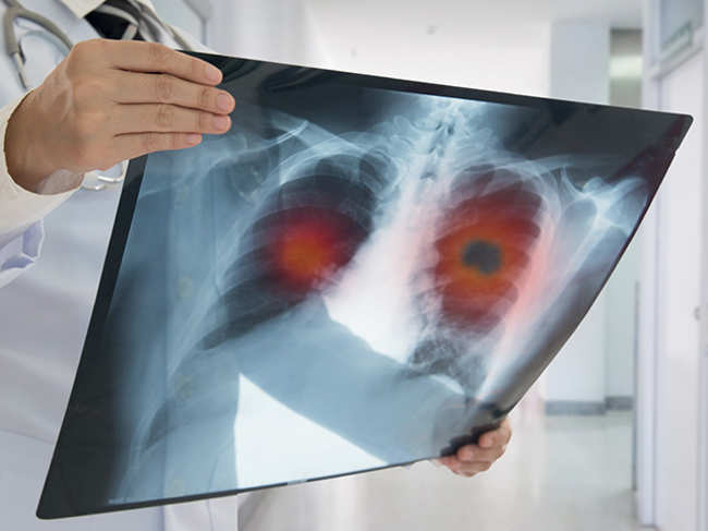 lung-cancer-GettyImages-920406350