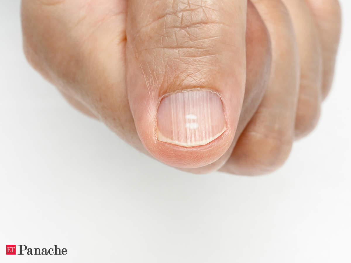 Nails Infections Anemia Psoriasis What Nails Can Reveal About Your Health The Economic Times