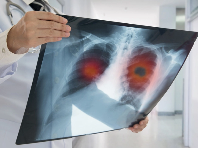 Lung Cancer World Cancer Day Immunotherapy Can Help Patients Suffering From Carcinoma Of The Lungs The Economic Times