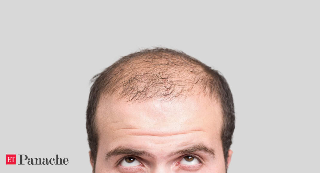 Baldness: Say goodbye to baldness: New, low-cost tech can reactivate hair  production - The Economic Times