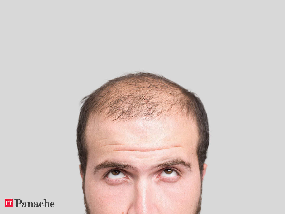 Baldness: Say goodbye to baldness: New, low-cost tech can reactivate hair  production - The Economic Times