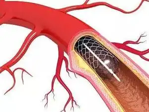 Stent