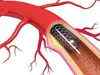 Patients' group opposes stent categorisation