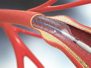 stents-getty