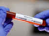 Coronavirus outbreak: 6 samples from Noida test negative