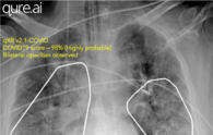 Qure.ai can detect Covid-19 lung infections in less than a minute, help triage patients