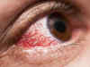 People suffering from diabetic eye disease five times more likely to get severe Covid