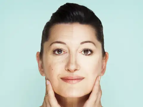 Midface fat volume